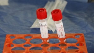 Coronavirus Marche, nelle ultime 24 ore risultati 82 tamponi positivi su 437 analizzati