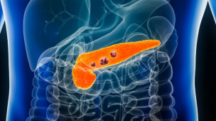 Cancro al pancreas, svolta dalla Spagna: eliminate le cellule tumorali nei test sui topi