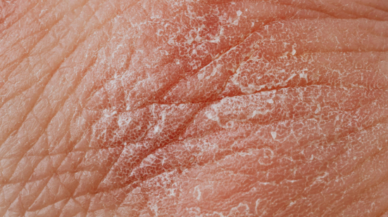 Fano, Open Day psoriasi all’Ospedale Santa Croce: visite gratuite e prevenzione