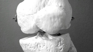 Giornata mondiale dell’osteoporosi: l’AST guida la prevenzione nelle Marche con “Ossi duri… si diventa”